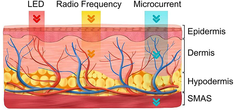 How to Choose the Perfect At-Home RF Beauty Device: A Comprehensive Guide