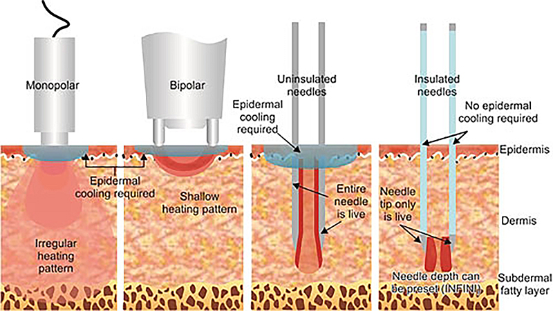 The Evolution of Radio Frequency Technology in At-Home Beauty Devices
